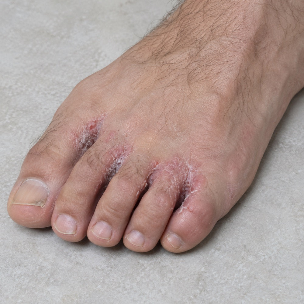 Athlete's Foot in Footballers: Causes, Prevention, What Actually Works