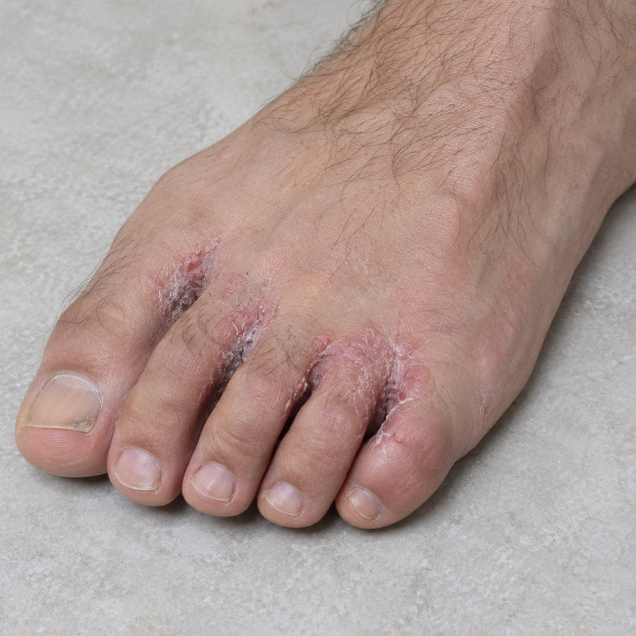 Athlete's Foot in Footballers: Causes, Prevention, What Actually Works